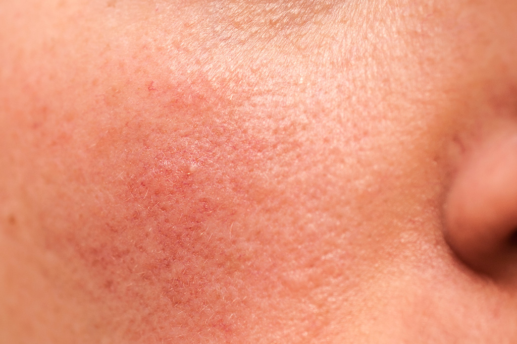 rosacea